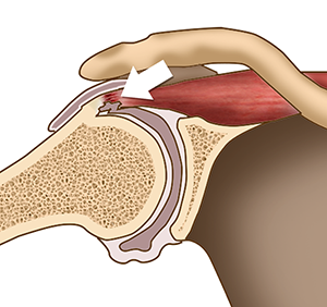Unicondylar Knee Replacement