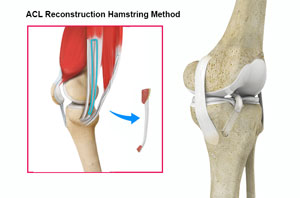 ACL Reconstruction Procedure with Hamstring Tendon