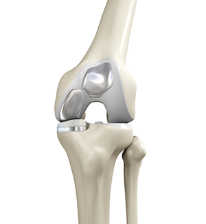 Women and ACL Injuries