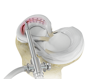 Women and ACL Injuries