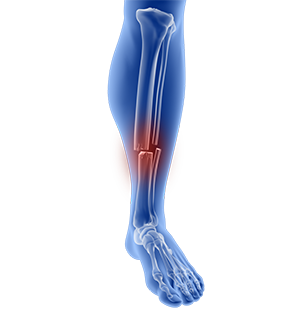 Women and ACL Injuries