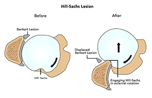 Unicondylar Knee Replacement