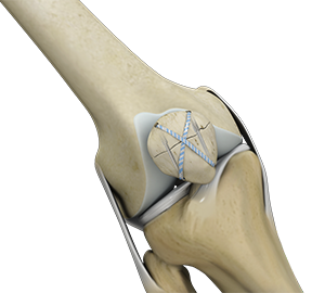 Women and ACL Injuries