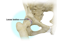 Loose Bodies in the Knee