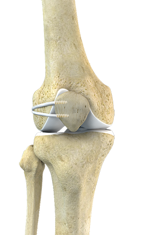 Women and ACL Injuries