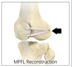  Medial Patellofemoral Ligament Reconstruction