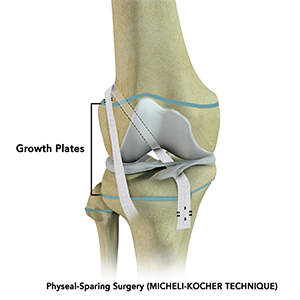  Physeal Sparing Surgery (Micheli-KocherTechnique)