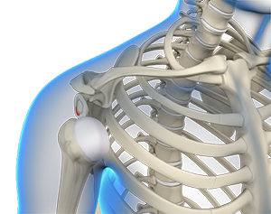 Unicondylar Knee Replacement