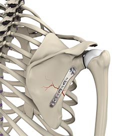 ORIF of the Clavicle Fractures
