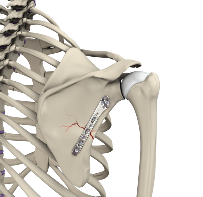  ORIF of the Clavicle Fractures