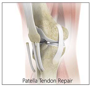  Patellar Tendon Repair