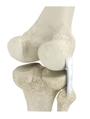 Women and ACL Injuries