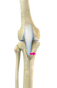 Tibial Derotational Osteotomy