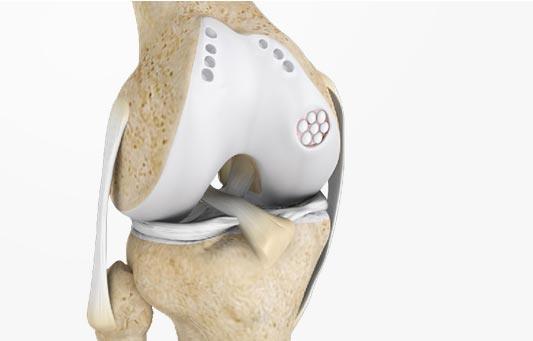 cartilage restoration